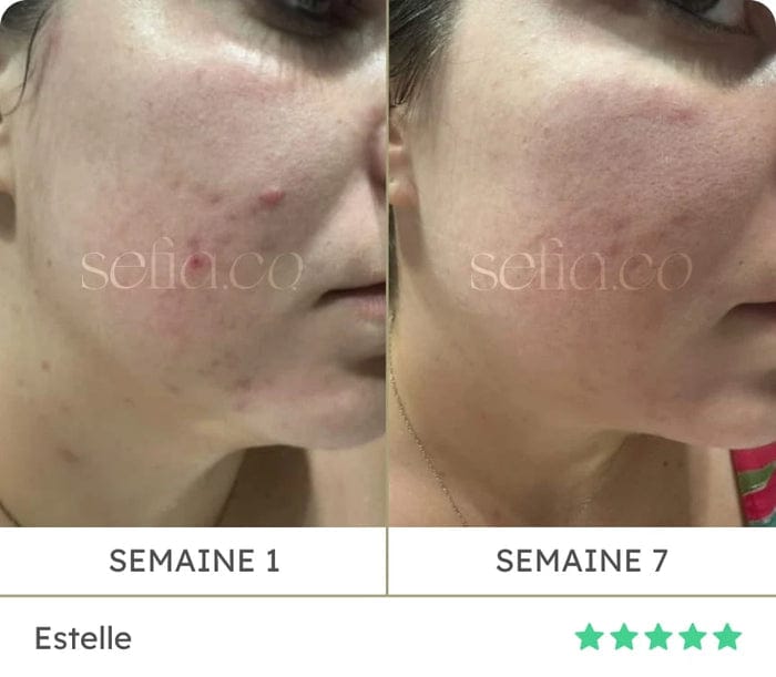 Avant / après d'Estelle : semaine 1 puis semaine 7