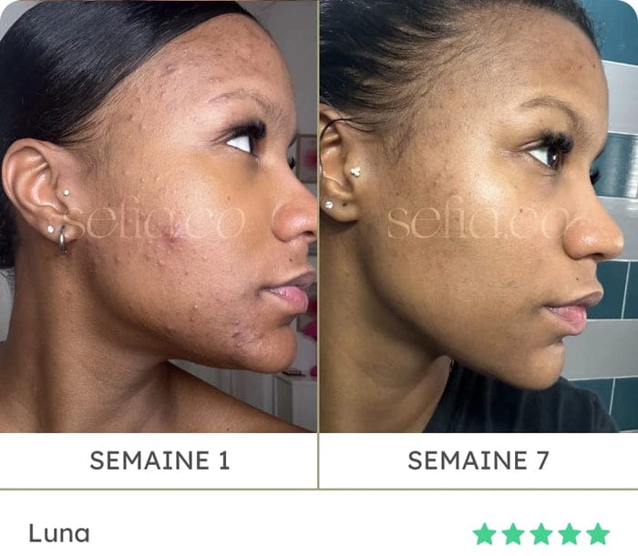 Avant / après de Luna : semaine 1 puis semaine 7