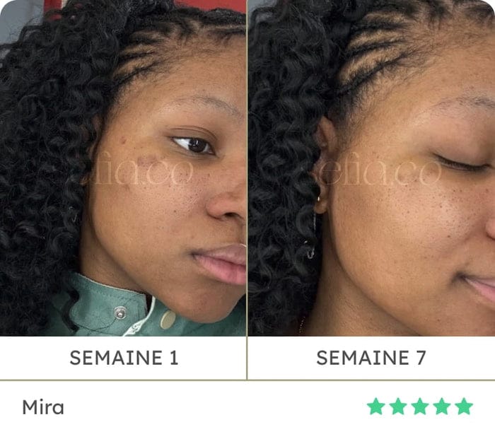 Avant / après de Mira : semaine 1 puis semaine 7