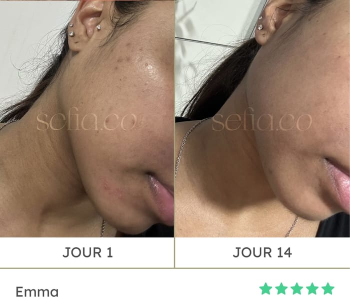 Avant / après d'Emma