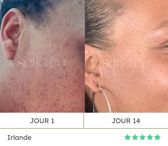 Avant / après d'Irlande