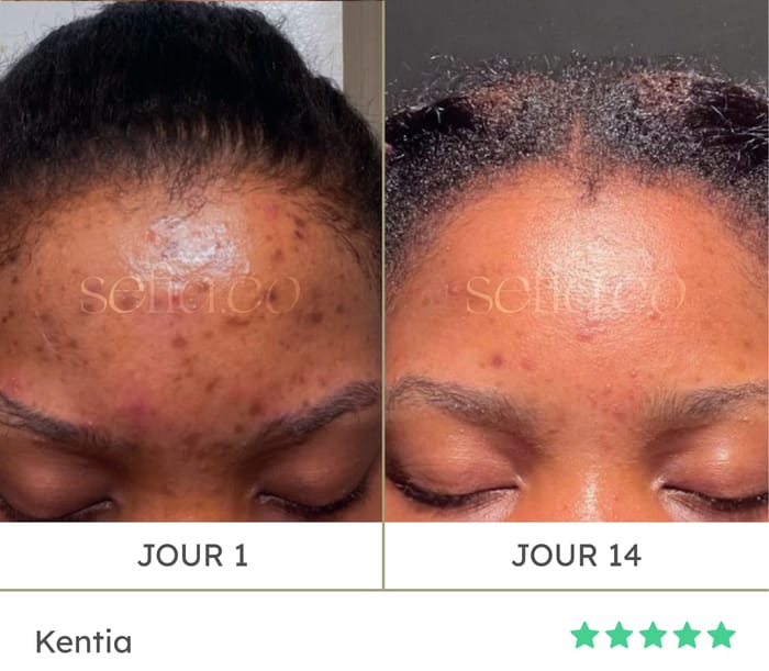 Avant / après de Kentia